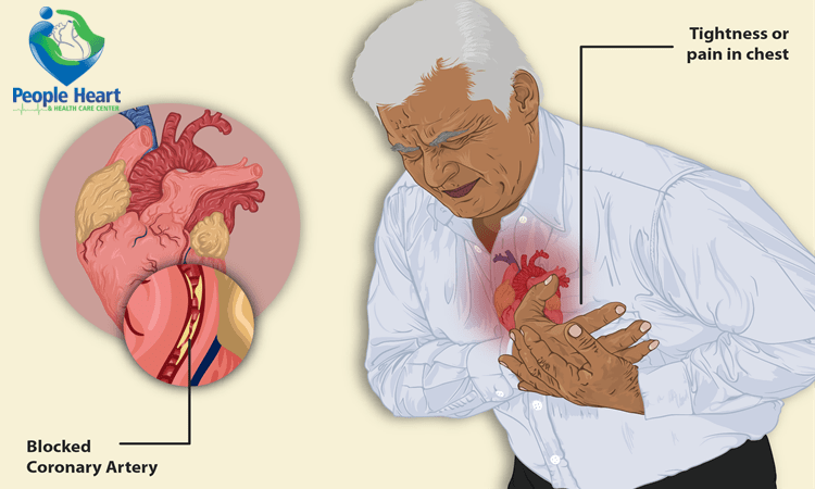 What is heart attack, Types of Heart Attack
