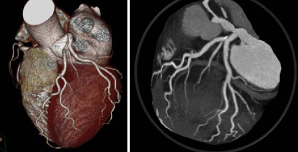 CT Coronary