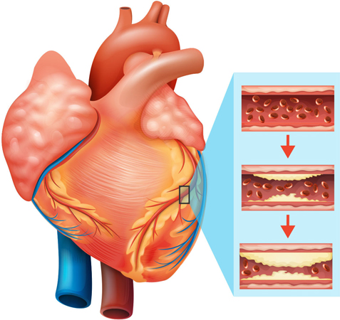 heart-blockage-treatment-jaipur