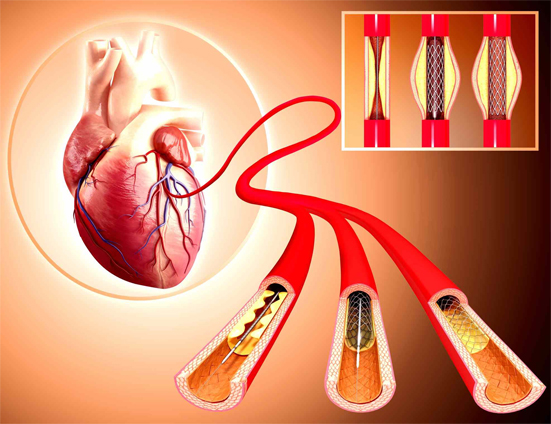 heart treatment without stent in jaipur