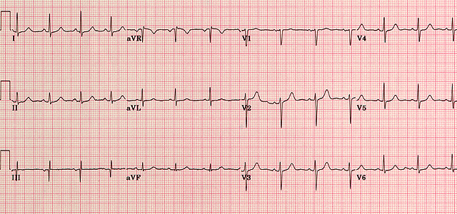 eecp-treatment